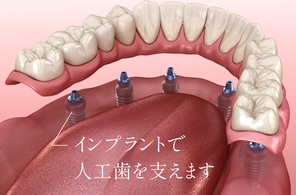 インプラントで人工歯を支えます